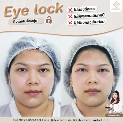 รีวิว เทคนิค EYELOCK ตัดถุงใต้ตา