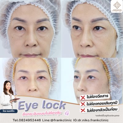 รีวิว เทคนิค EYELOCK ตัดถุงใต้ตา