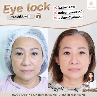 รีวิว เทคนิค EYELOCK ตัดถุงใต้ตา