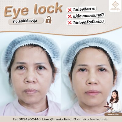 รีวิว เทคนิค EYELOCK ตัดถุงใต้ตา