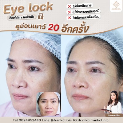 รีวิว เทคนิค EYELOCK ตัดถุงใต้ตา