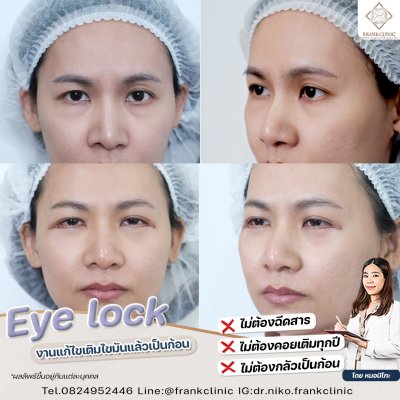 รีวิว เทคนิค EYELOCK ตัดถุงใต้ตา