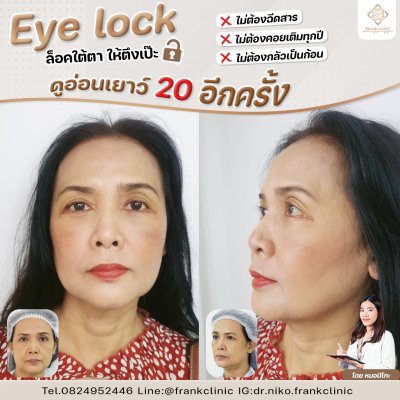 รีวิว เทคนิค EYELOCK ตัดถุงใต้ตา