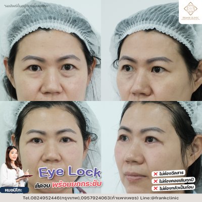 รีวิว เทคนิค EYELOCK ตัดถุงใต้ตา