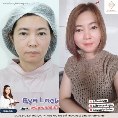 รีวิว เทคนิค EYELOCK ตัดถุงใต้ตา