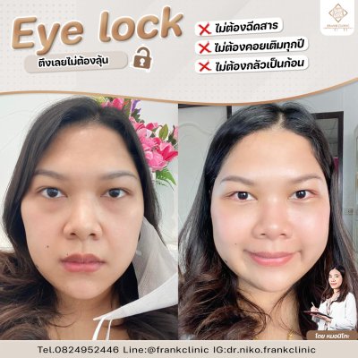 รีวิว เทคนิค EYELOCK ตัดถุงใต้ตา