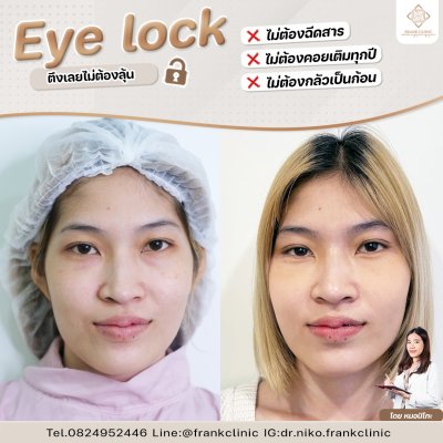 รีวิว เทคนิค EYELOCK ตัดถุงใต้ตา