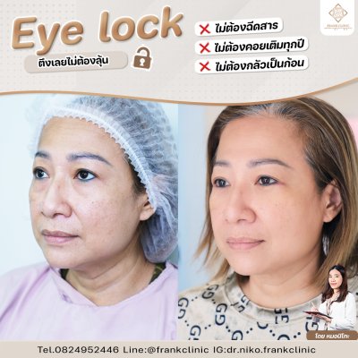 รีวิว เทคนิค EYELOCK ตัดถุงใต้ตา