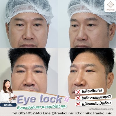 รีวิว เทคนิค EYELOCK ตัดถุงใต้ตา