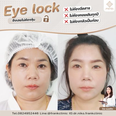 รีวิว เทคนิค EYELOCK ตัดถุงใต้ตา