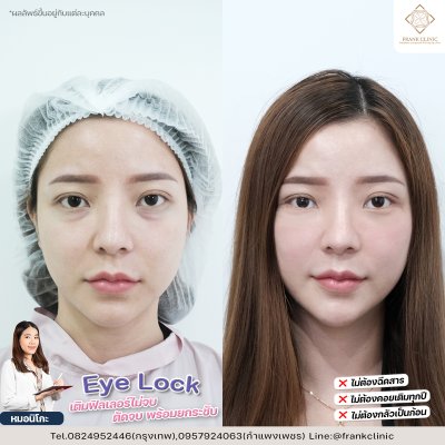 รีวิว เทคนิค EYELOCK ตัดถุงใต้ตา