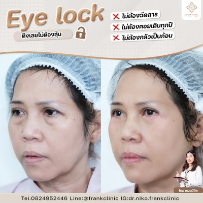 รีวิว เทคนิค EYELOCK ตัดถุงใต้ตา