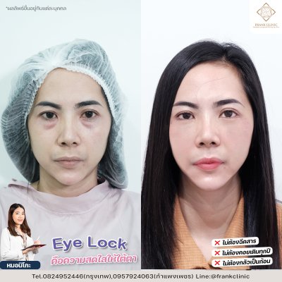 รีวิว เทคนิค EYELOCK ตัดถุงใต้ตา