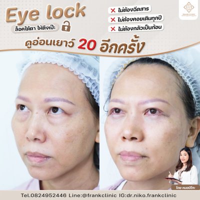 รีวิว เทคนิค EYELOCK ตัดถุงใต้ตา