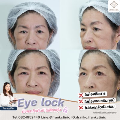 รีวิว เทคนิค EYELOCK ตัดถุงใต้ตา