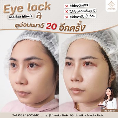 รีวิว เทคนิค EYELOCK ตัดถุงใต้ตา