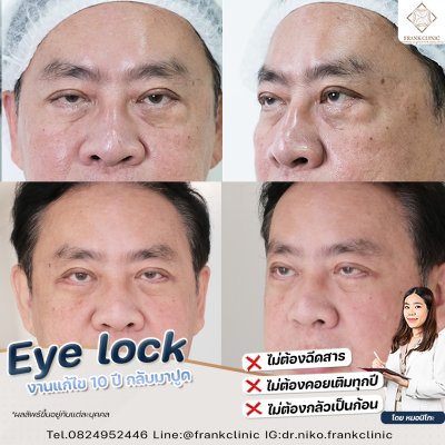 รีวิว เทคนิค EYELOCK ตัดถุงใต้ตา