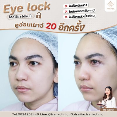 รีวิว เทคนิค EYELOCK ตัดถุงใต้ตา