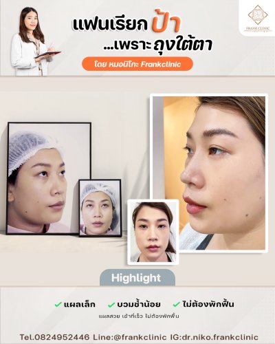 รีวิว ตัดถุงใต้ตา