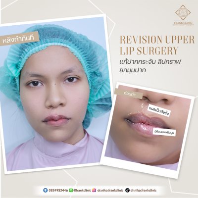 รีวิว ศัลยกรรม ปากกระจับ 2 (Lip surgery)