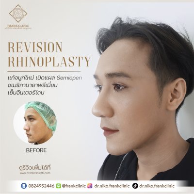 รีวิว เสริมจมูก (Rhinoplasty)