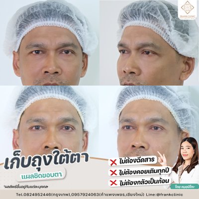 รีวิว ตัดถุงใต้ตา