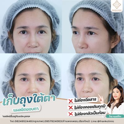 รีวิว ตัดถุงใต้ตา