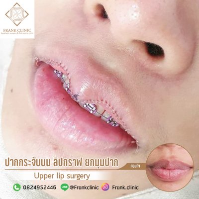 รีวิว ศัลยกรรม ปากกระจับ (Lip surgery)