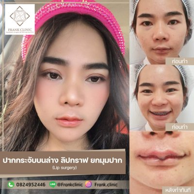 รีวิว ศัลยกรรม ปากกระจับ (Lip surgery)