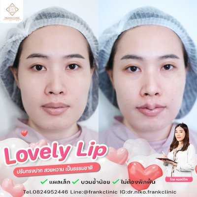 รีวิว ศัลยกรรม ปากกระจับ 2 (Lip surgery)