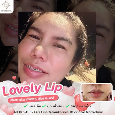 รีวิว ศัลยกรรม ปากกระจับ 2 (Lip surgery)