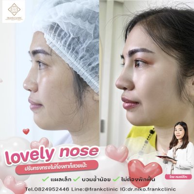 รีวิว เสริมจมูก (Rhinoplasty)