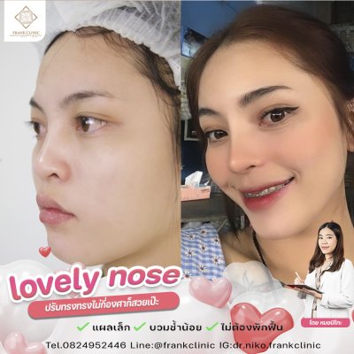 รีวิว เสริมจมูก (Rhinoplasty)