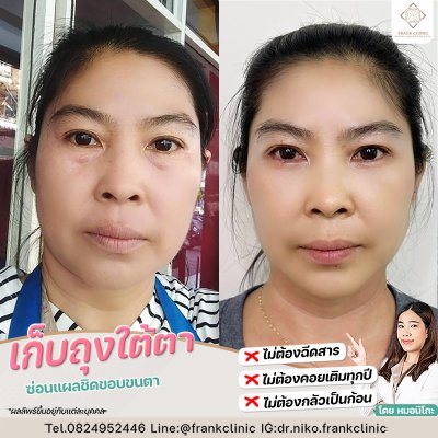 รีวิว ตัดถุงใต้ตา