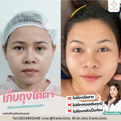 รีวิว ตัดถุงใต้ตา