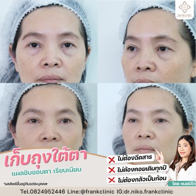 รีวิว ตัดถุงใต้ตา