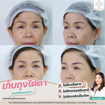 รีวิว ตัดถุงใต้ตา