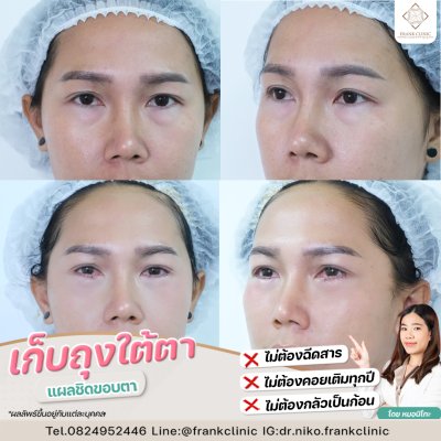 รีวิว ตัดถุงใต้ตา