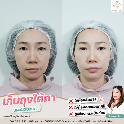 รีวิว ตัดถุงใต้ตา