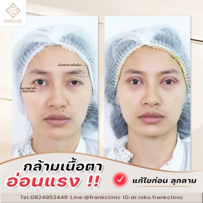 รีวิว กล้ามเนื้อตาอ่อนแรง