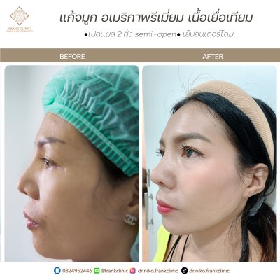 รีวิว เสริมจมูก (Rhinoplasty)