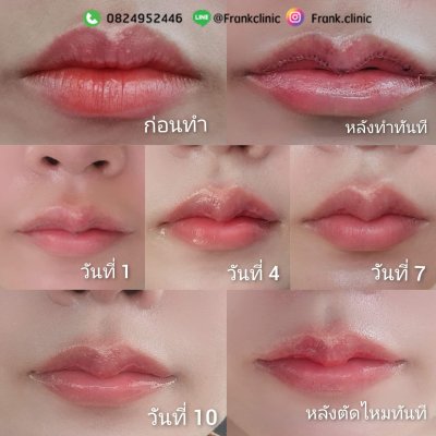 รีวิว ศัลยกรรม ปากกระจับ (Lip surgery)