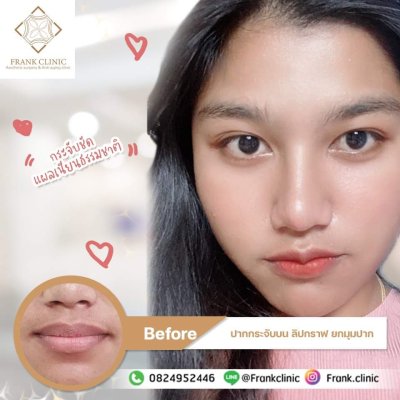 รีวิว ศัลยกรรม ปากกระจับ (Lip surgery)