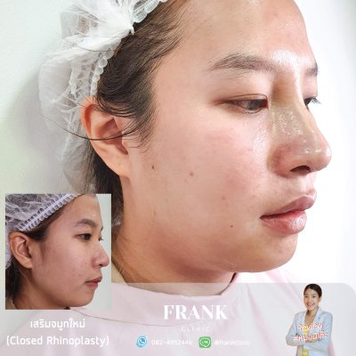 รีวิว เสริมจมูก (Rhinoplasty)