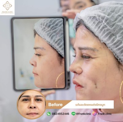 รีวิว เสริมจมูก (Rhinoplasty)