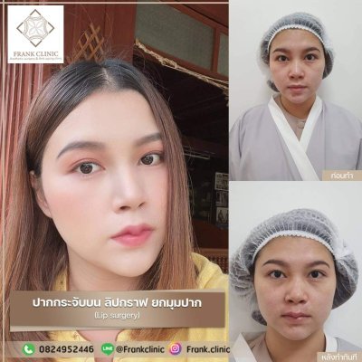 รีวิว ศัลยกรรม ปากกระจับ (Lip surgery)