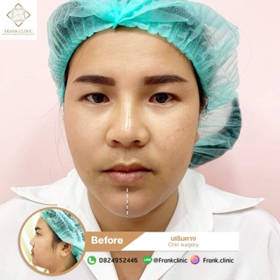 รีวิว เสริมคาง (Chin surgery)