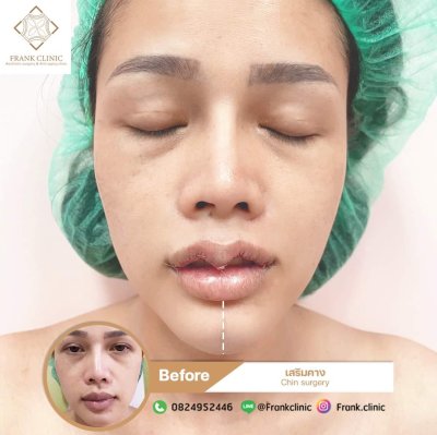 รีวิว เสริมคาง (Chin surgery)