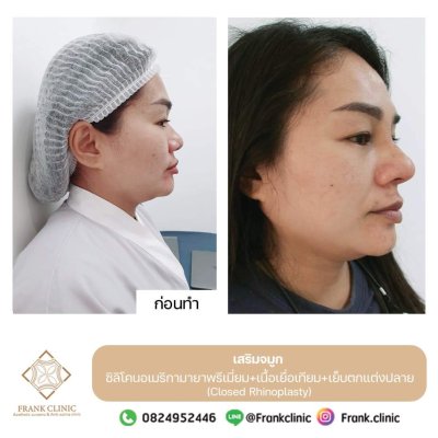 รีวิว เสริมจมูก (Rhinoplasty)