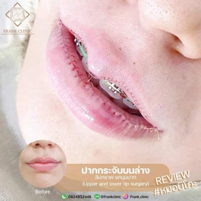 รีวิว ศัลยกรรม ปากกระจับ (Lip surgery)